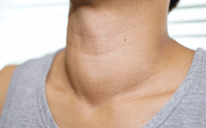 Neck Lump The Silent Siren of Stage 3 Thyroid Cancer