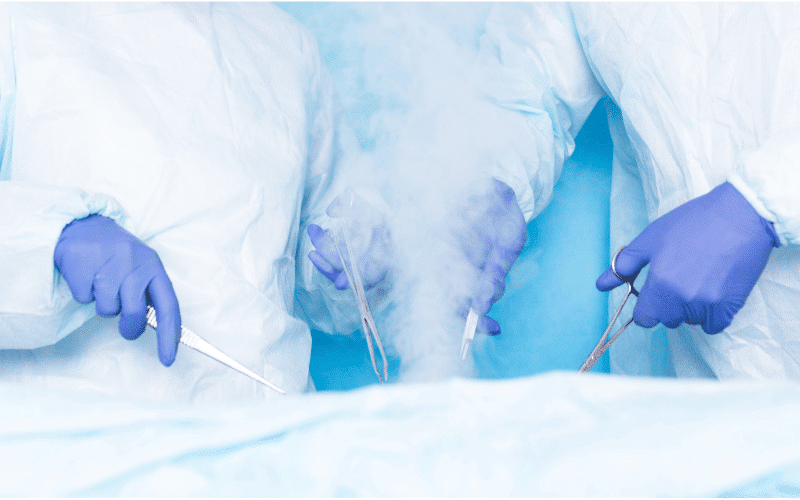 Cryosurgery Freezing Cancer in its Tracks