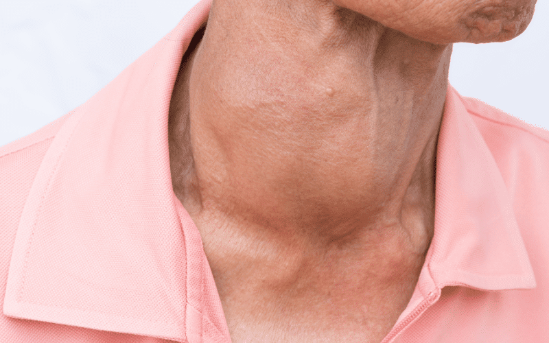 Goiter The Bulging Marker of Iodine Scarcity