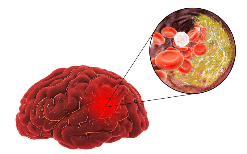 Cerebrovascular Conditions The Crucial Link to VaD