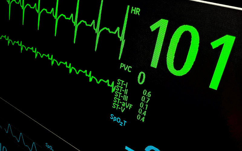 Rapid or Irregular Heartbeat A Troubling Symptom of Multinodular Goiter