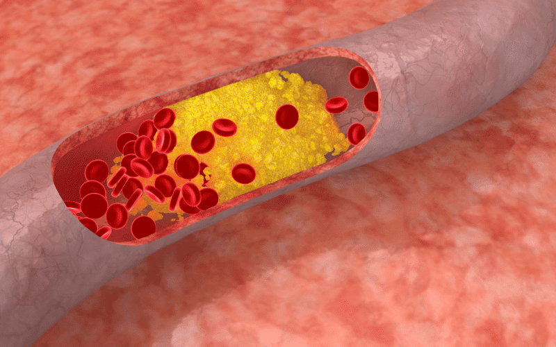 The Lipid Connection Cholesterol and Chronic SVD