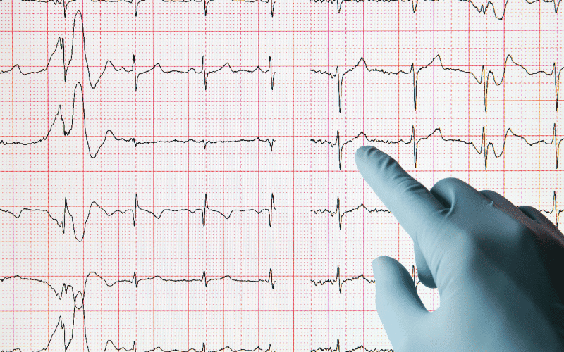 Arrhythmogenic Right Ventricular Cardiomyopathy Unraveling the Replacement Issue