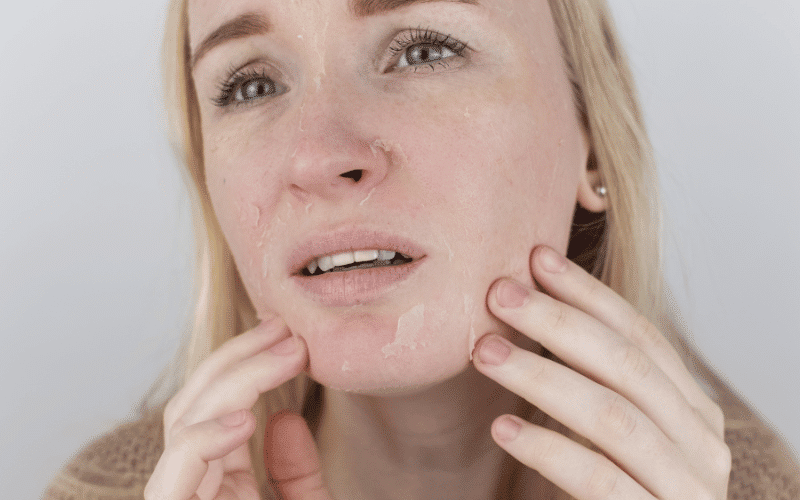 Dry Skin - A Subtle Sign of Low Iodine