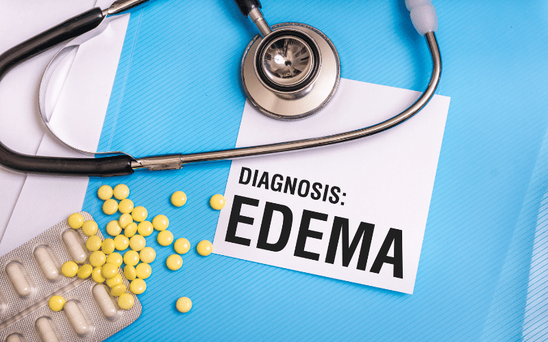 Edema A Sign of Trouble Brewing