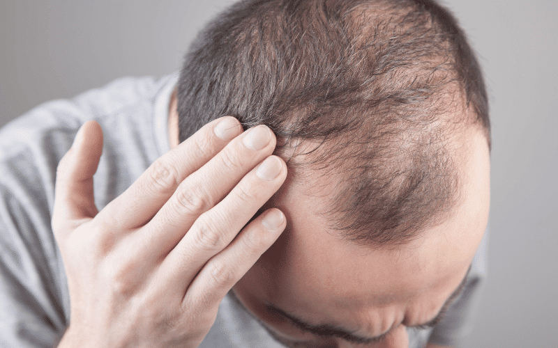 Hair Loss The Unwanted Impact of Iodine Deficiency