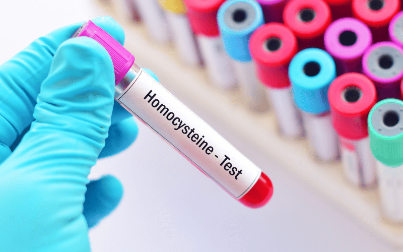 High Homocysteine Levels - An Overlooked Factor in Vascular Dementia