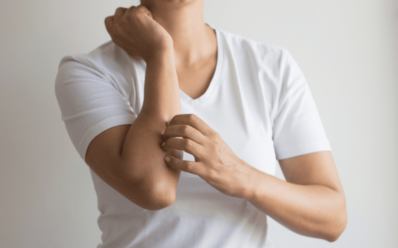 Itching - An Under-Recognized Symptom of MTC