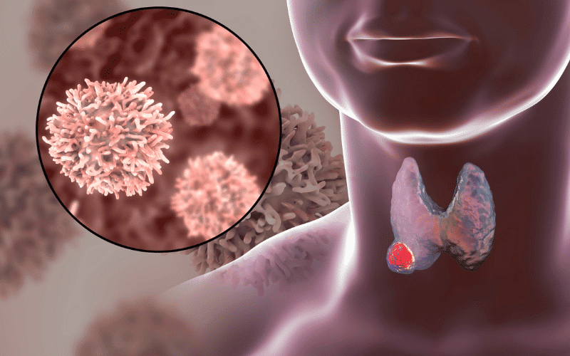 Prior History of Thyroid Cancer or Other Neoplasms