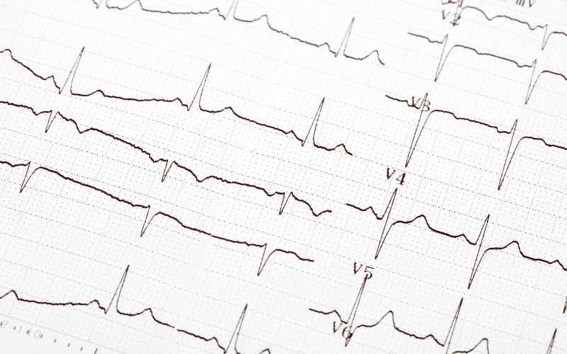 Rapid or Irregular Heartbeat - More than Just a Scare