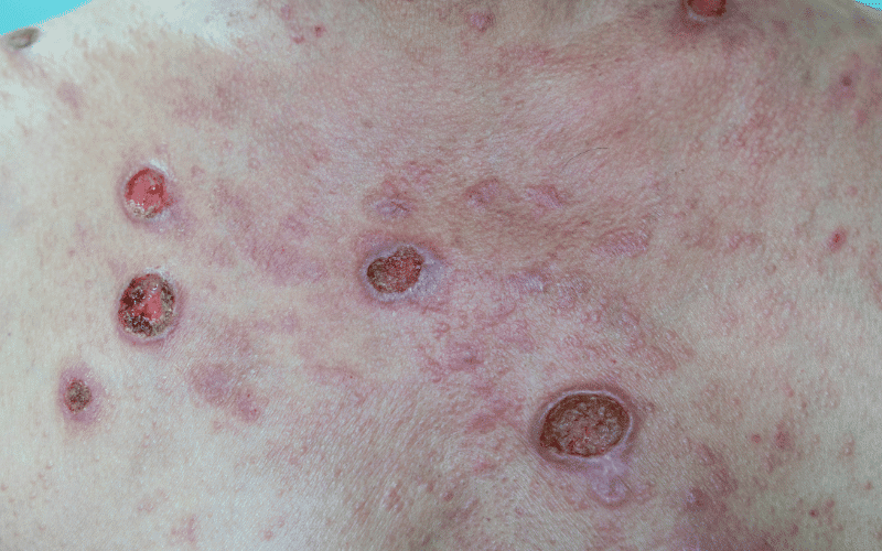 Skin Erosions and Ulcers The Deteriorating Stages