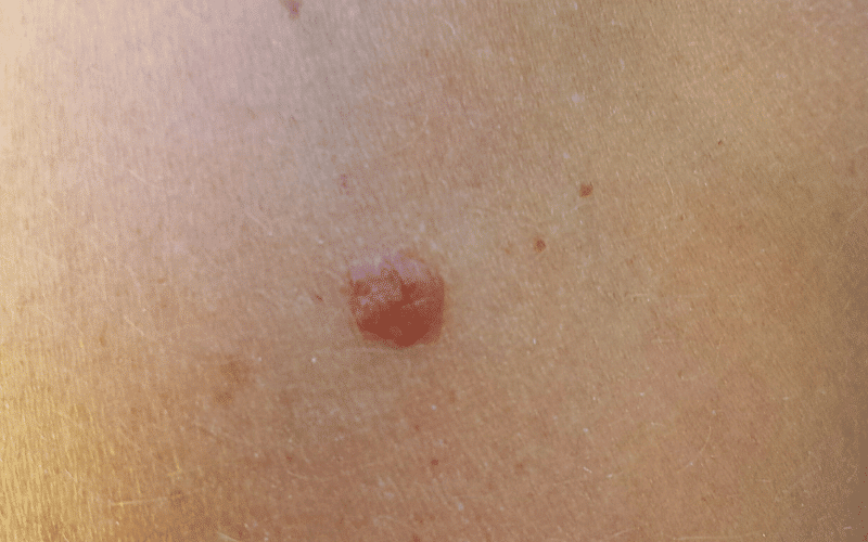 Skin Lesions The Visible Indicators of Cowden Syndrome