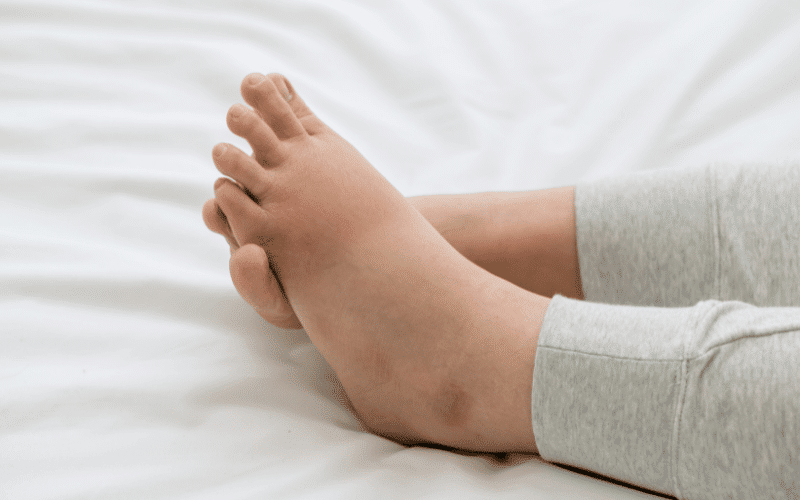 Swelling in the Legs, Ankles, and Feet - More than Just Standing for Too Long