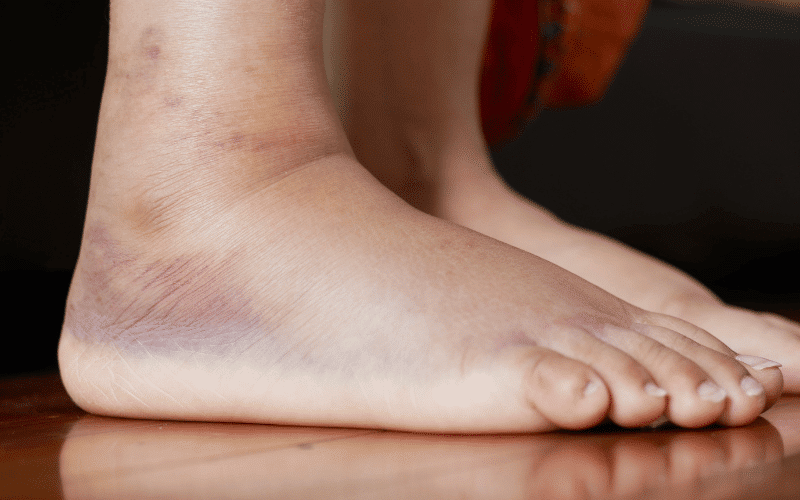 Swollen Legs, Feet, and Ankles The Underestimated Markers of Heart Disease