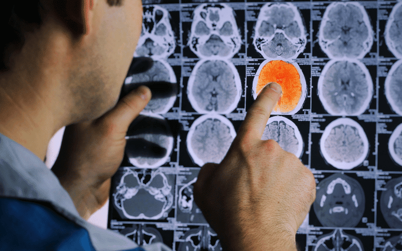 Transient Ischemic Attacks (TIAs) The Warning Mini-Strokes of CAA