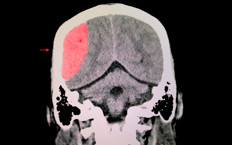 Fact 6: The Burden of Traumatic Brain Injury on Healthcare Systems