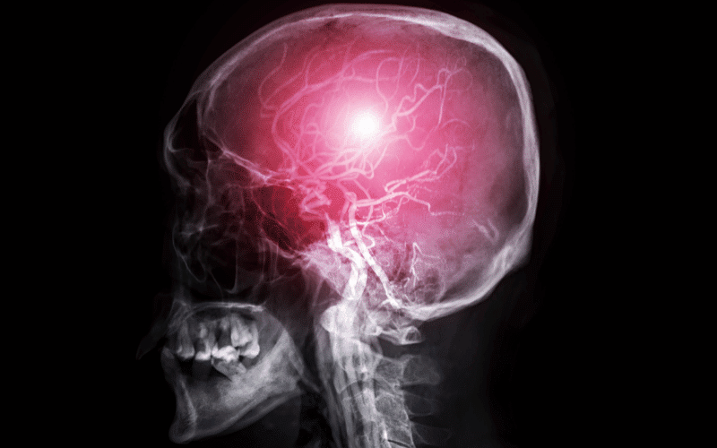 Cerebral Amyloid Angiopathy (CAA) A 15-Fact Journey