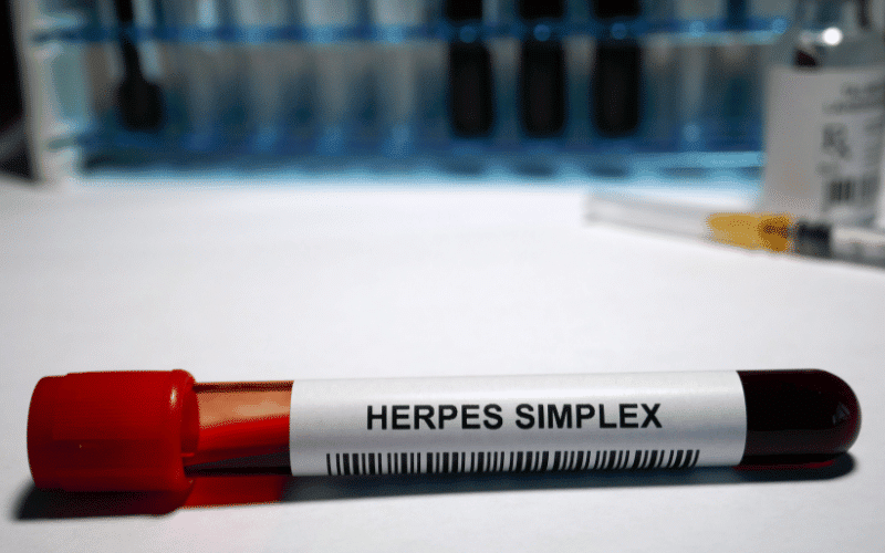 The Underlying Cause Herpes Simplex Virus