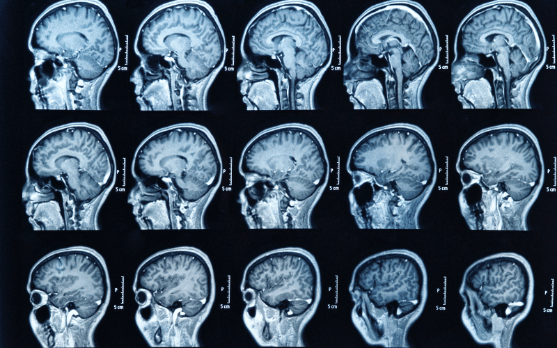 Alcohol-Related Dementia and Brain Changes