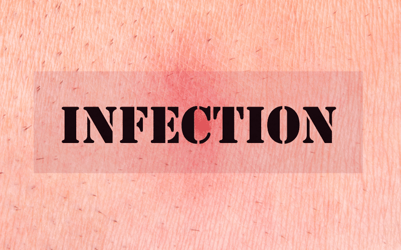 The Unexpected Link Neuropathy and Infections