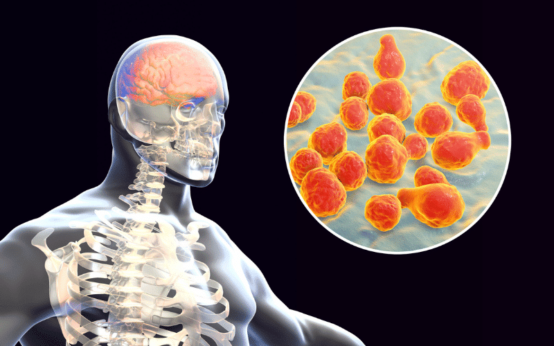 Fungal Meningitis The Slow, Stealthy Foe