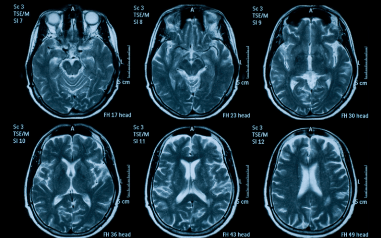 Unraveling Olivopontocerebellar Atrophy (OPCA): Decoding the 10 Key ...