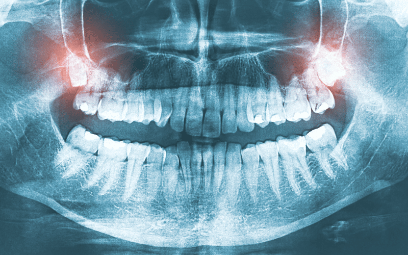 Dental Abnormalities