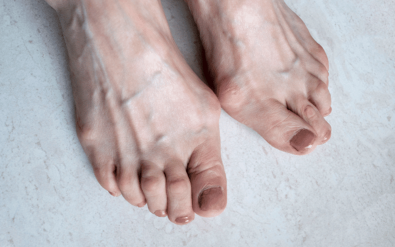 Foot Abnormalities The Unsteady Steps of FRDA