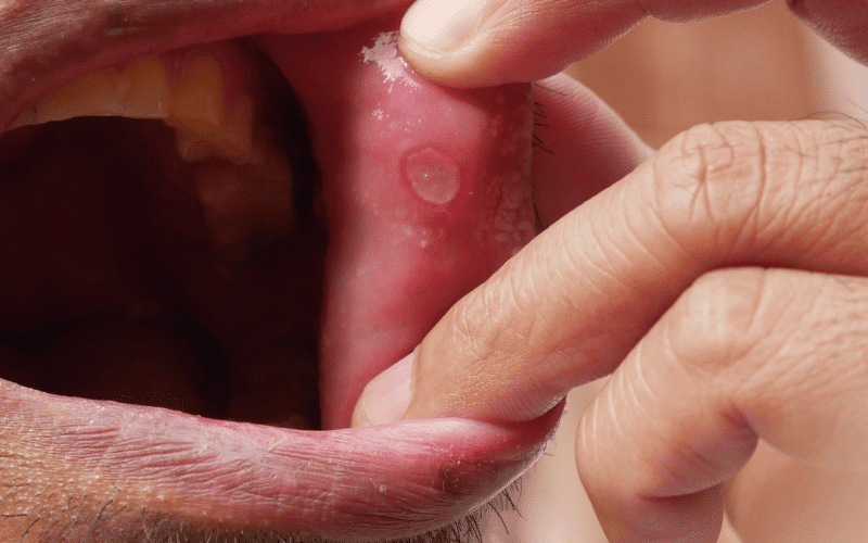 Mouth Ulcers - The Initial Telltale Sign of Behcet's Disease