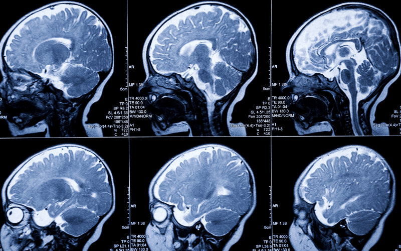 Navigating the Complexities of Metachromatic Leukodystrophy Identifying the Key Symptoms