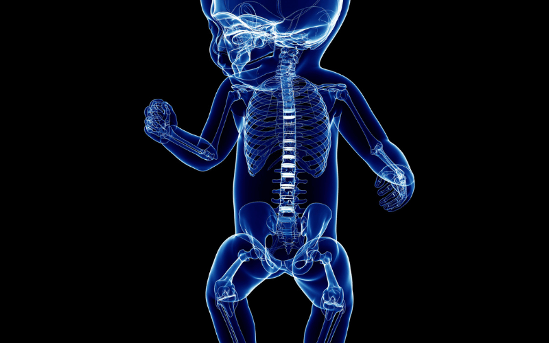 Skeletal Abnormalities The Hidden Signs of Mucolipidosis