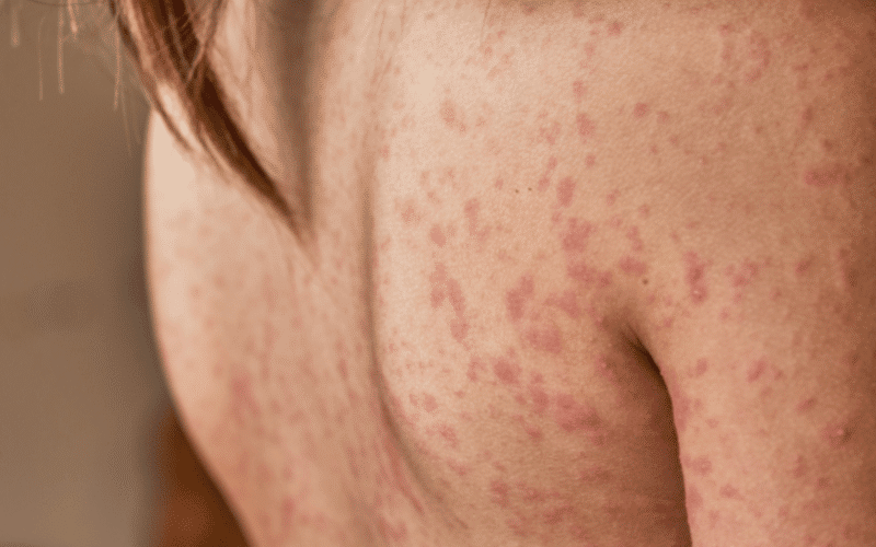 Skin Rash A Distinctive Marker of Meningitis