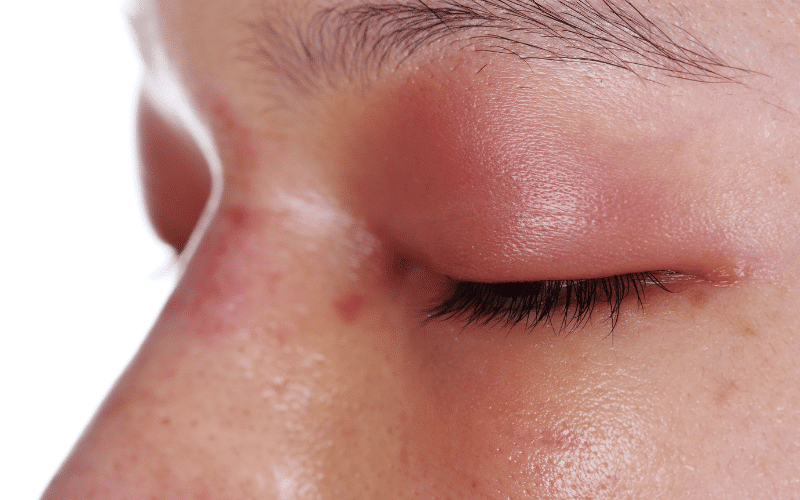 Swelling and Bulging of the Eye - A Late Indicator