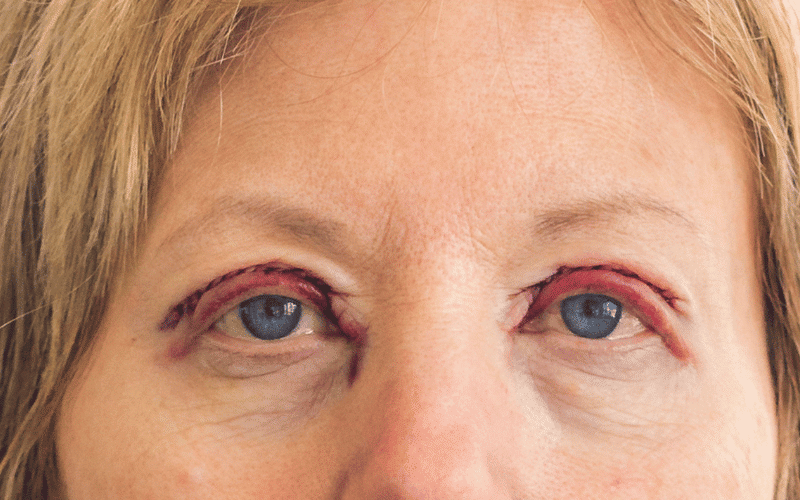 The Ominous Sign of Eyelid Drooping