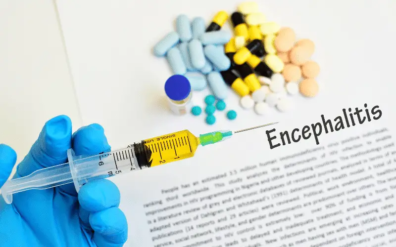 Unmasking Herpesviral Encephalitis 15 Crucial Facts to Know