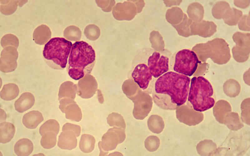 A Closer Look at the Leading Indicators of LGL Leukemia