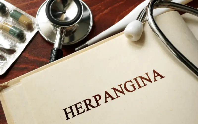 Beyond the Sore Throat 15 Critical Facts About Herpangina