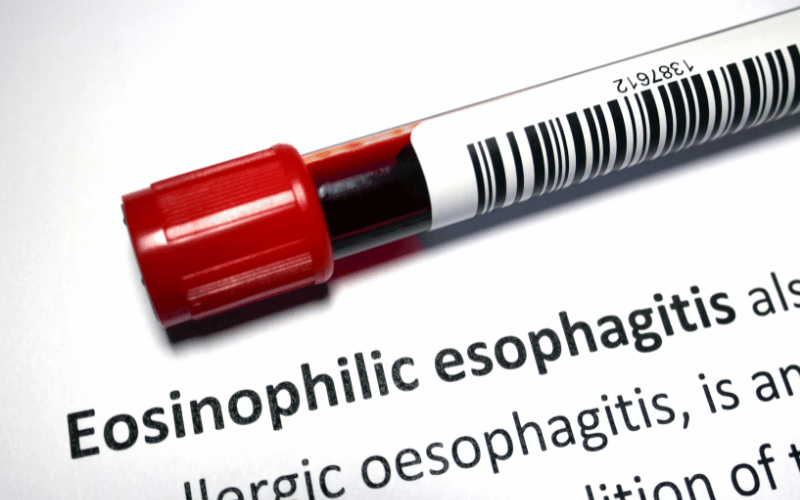 EoE Alert Recognize the Top 10 Signs of Eosinophilic Esophagitis Now