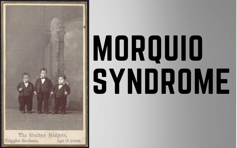 Examining the 10 Principal Symptoms of Morquio Syndrome