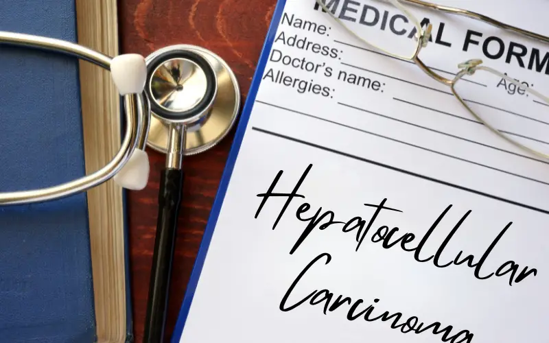 Hepatocellular Carcinoma Decoded 15 Facts You Can't Ignore