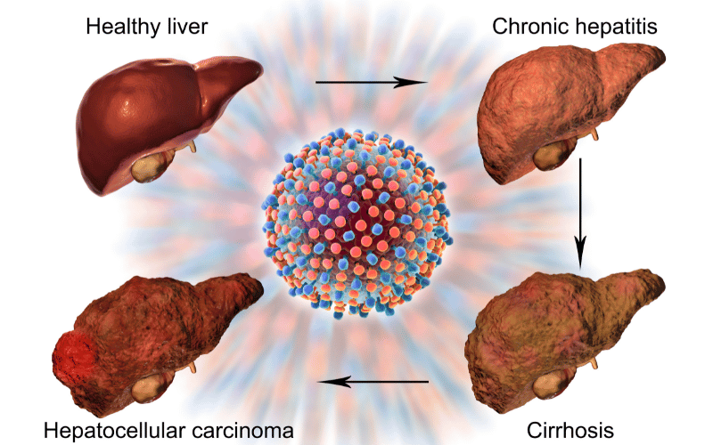 Hepatocellular Carcinoma Unveiled 10 Critical Symptoms to Take Seriously