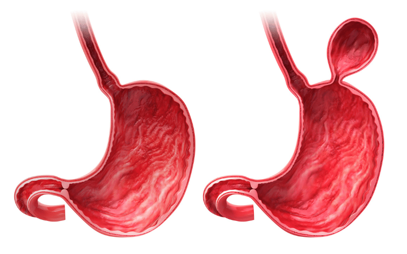 Hiatal Hernia Explained 10 Key Takeaways and Must-Know Details