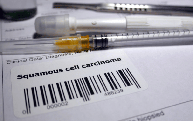 How to Spot Squamous-Cell Carcinoma of the Lung A 10 Symptom Checklist