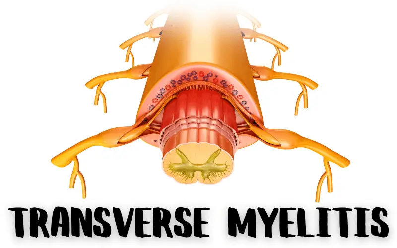 Inside Transverse Myelitis Discover 15 Essential Facts