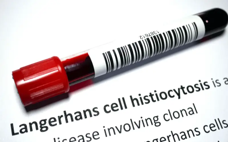 Langerhans Cell Histiocytosis What the Top 10 Symptoms Tell Us