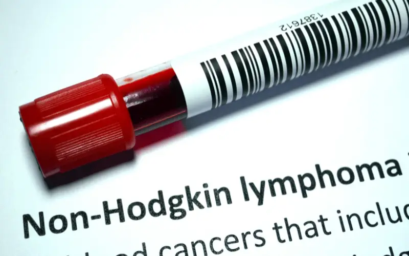 What Causes Non-Hodgkin's Lymphoma Top 10 Factors Revealed