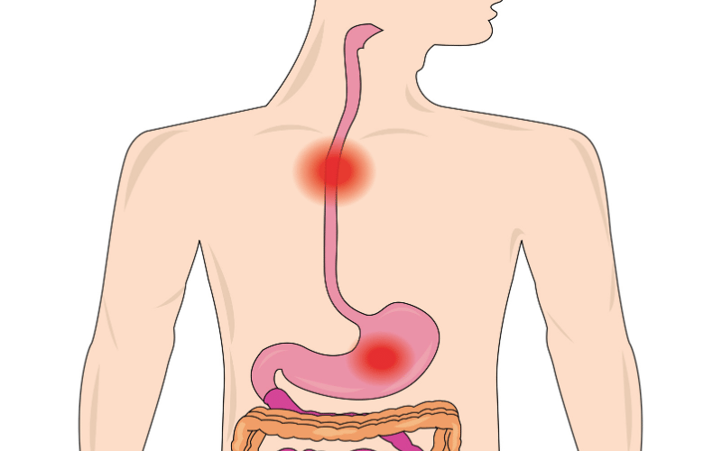 Your Quick-Read on the Top 10 Symptoms of Esophageal Achalasia