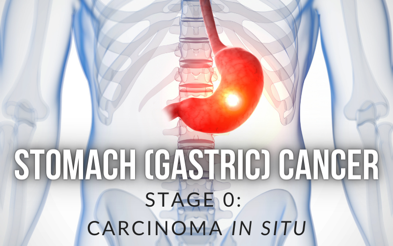Carcinoma in Situ The Dawn of Stomach Cancer