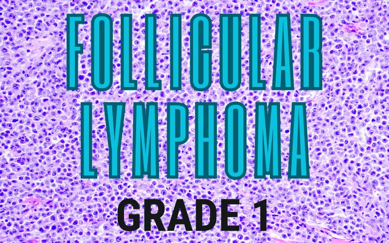 Indolent Yet Insightful The Nuances of Follicular Lymphoma Grade 1