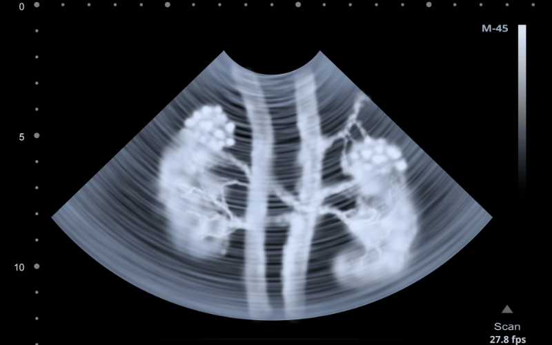 Kidney Problems The Sneaky Indicator